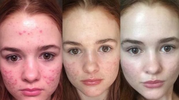 İLAÇ KULLANMADAN SİVİLCE İZLERİNDEN KURTULMAK MÜMKÜN