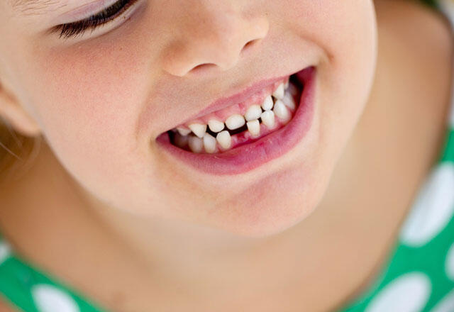 Çocuklarda Süt Dişlerinin Önemi