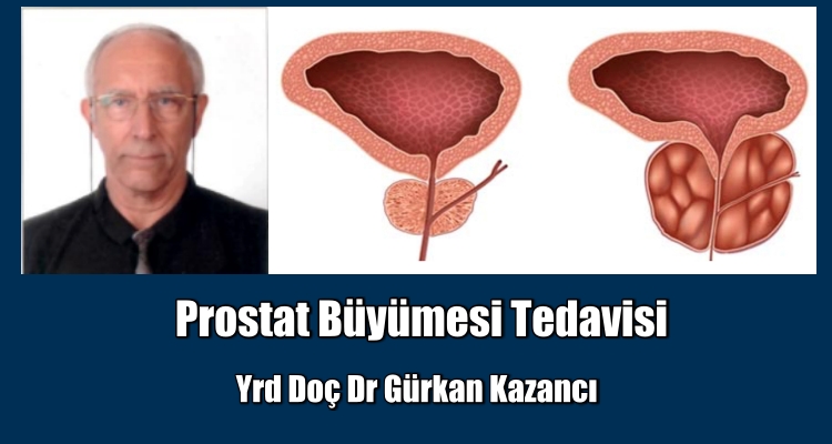 İyi Huylu Prostat Büyümesi Tedavisi