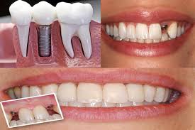 Diş İmplantı Sonrası Nelere Dikkat Edilmeli