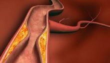 Damar Sertliği En Ölümcül Hastalıklar Arasında