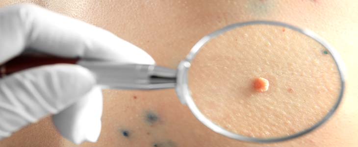 Her 10 Kişiden 1’inde HPV Virüsü Görülüyor!