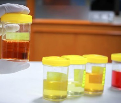 Hangi İdrar Rengi Hangi Hastalığın Habercisidir