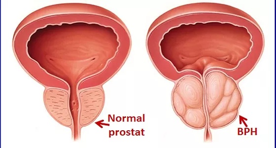 Prostat Problemi Yaşayan Erkeklere Holep Tedavisi