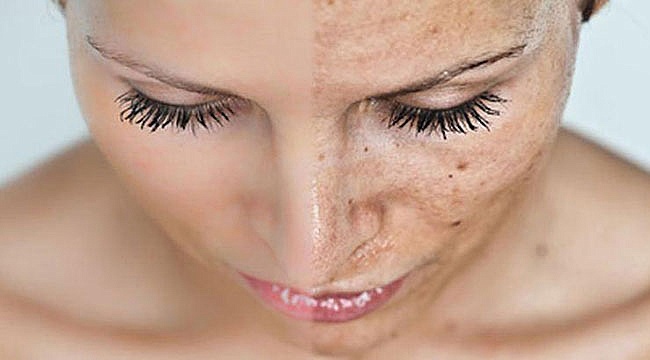 Yaz Ayında Cilt Lekelerine Dikkat