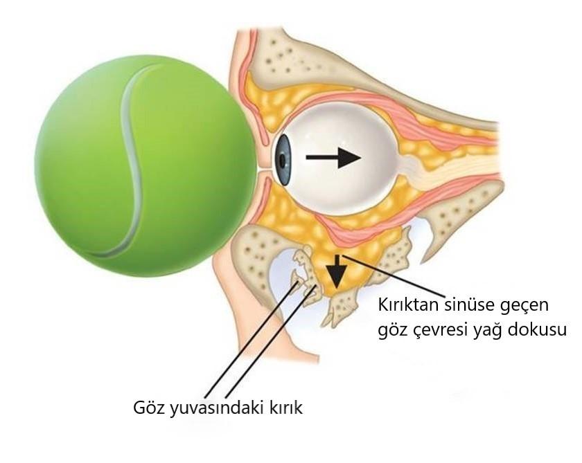 TENİS’te POTANSİYEL TEHLİKE; Blow Out Kırıkları